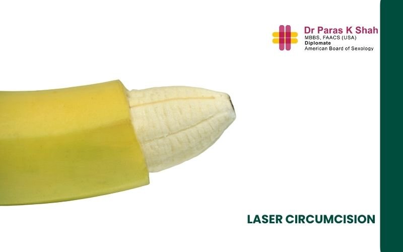 Laser Circumcision Treatment